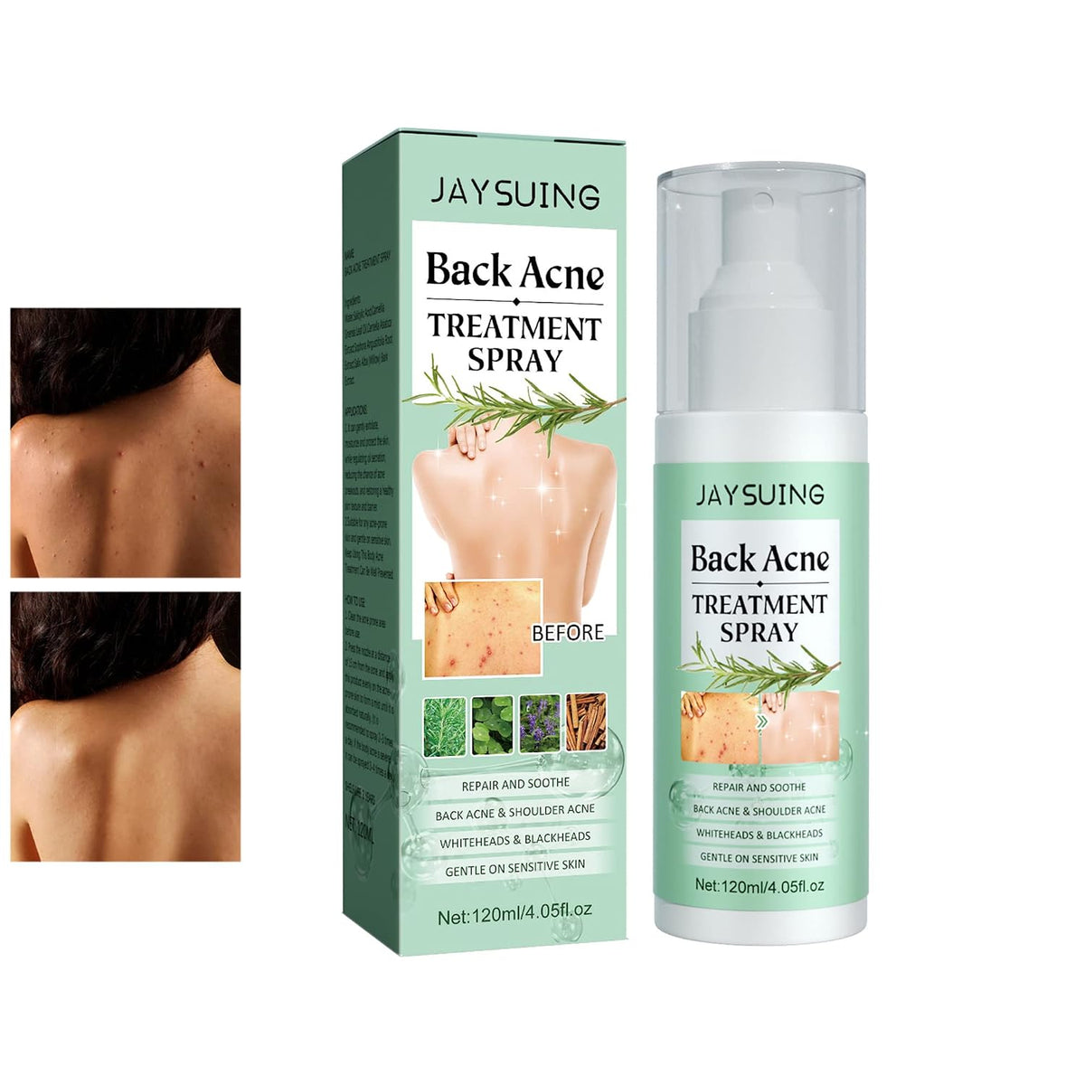 Back Acne Treatment Spray – Skincare Face Care