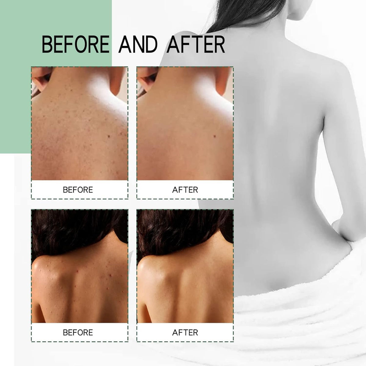 Back Acne Treatment Spray – Skincare Face Care