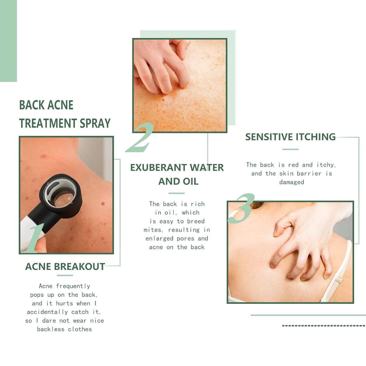 Back Acne Treatment Spray – Skincare Face Care